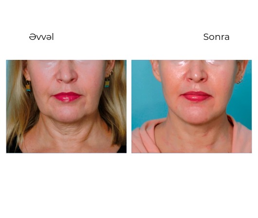 Candela GentleMax Pro Plus